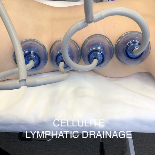 Lymphatic drainage treatment to get rid of cellulite