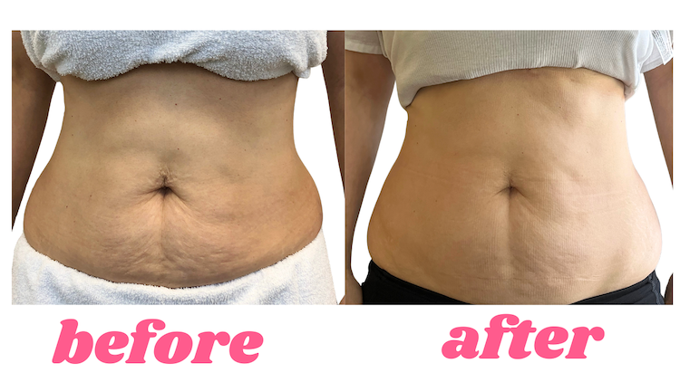 Before & After Starvac and Endospheres Lymphatic Drainage Massage Toronto Visible before and after results of Starvac lymphatic drainage massage showing reduced puffiness and smoother skin on abdomen