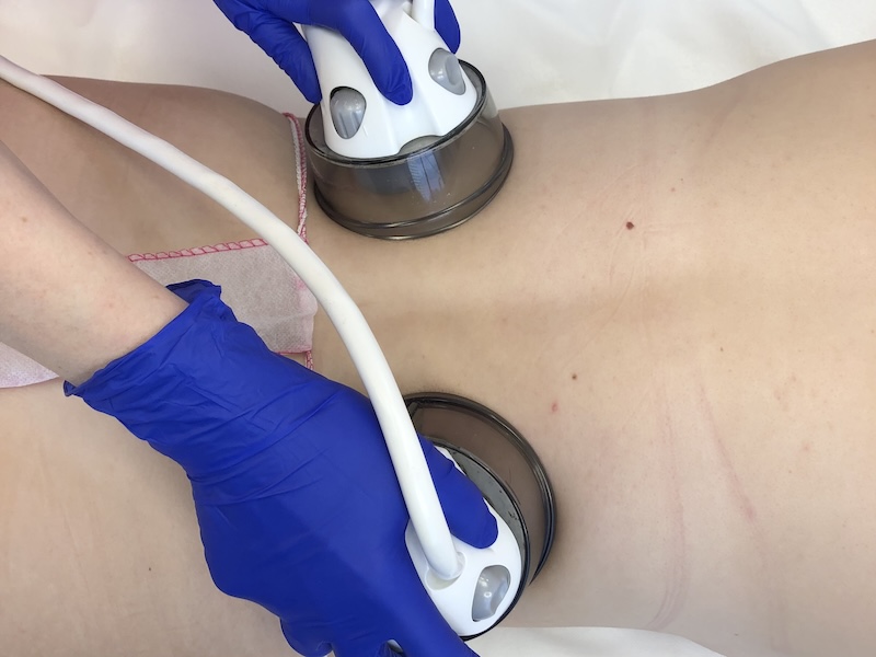 MedVSPA Starvac Lymphatic Drainage Massage in Toronto MedVSPA specialist performing Starvac lymphatic drainage massage for puffiness and detox.