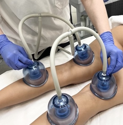 Starvac Lymphatic Drainage for Swelling Reduction Toronto Visible results of Starvac lymphatic drainage reducing puffiness and fluid retention in the legs.