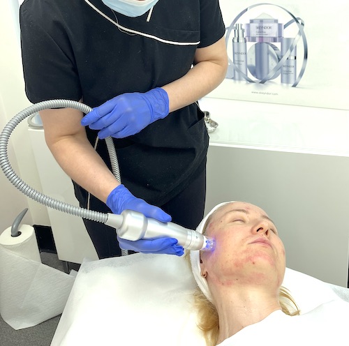 Radiofrequency Microneedling. Does It Actually Work? Expert Review