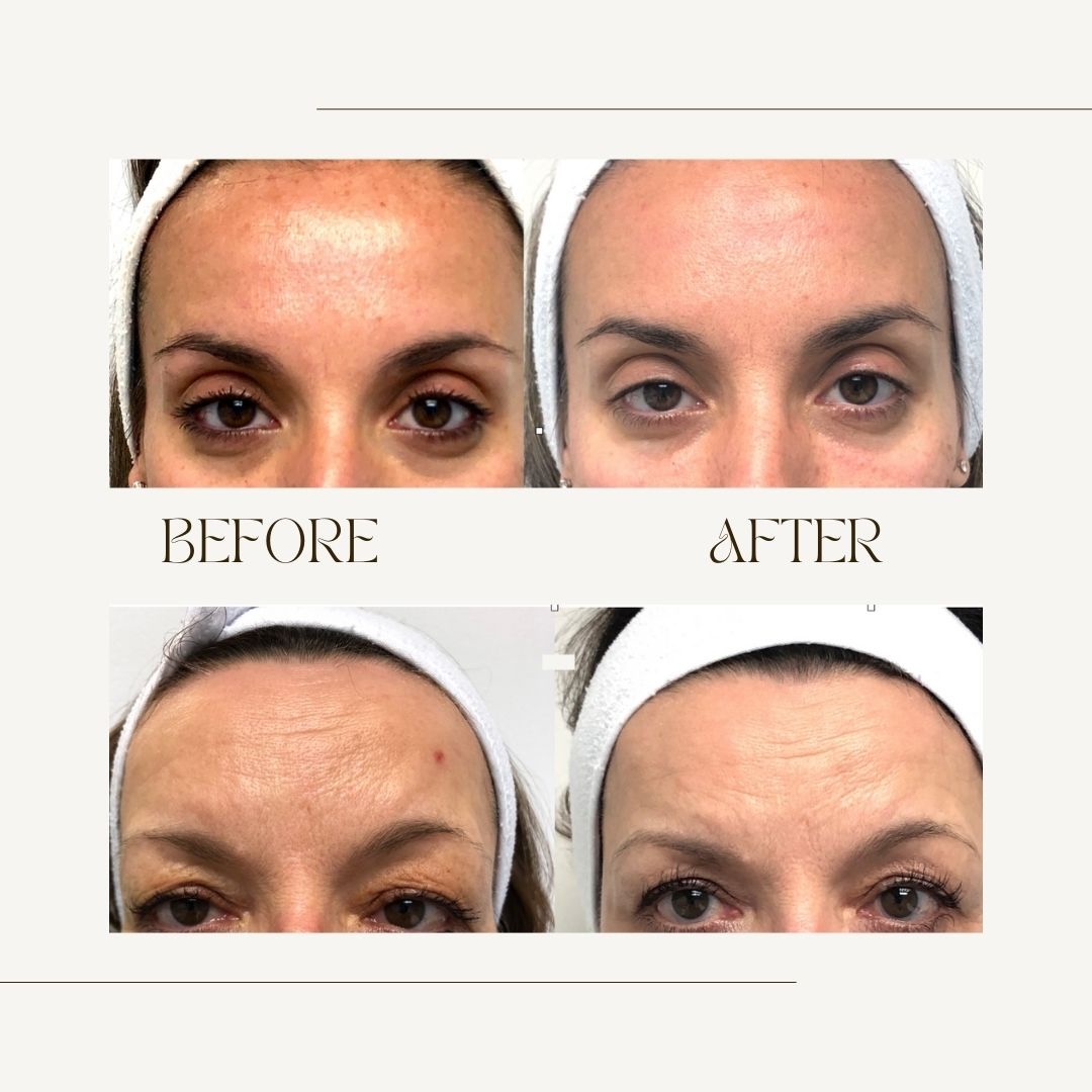 Botox Brow Lift Before and After Toronto Before and after Botox Brow Lift in Toronto showing natural eye lift