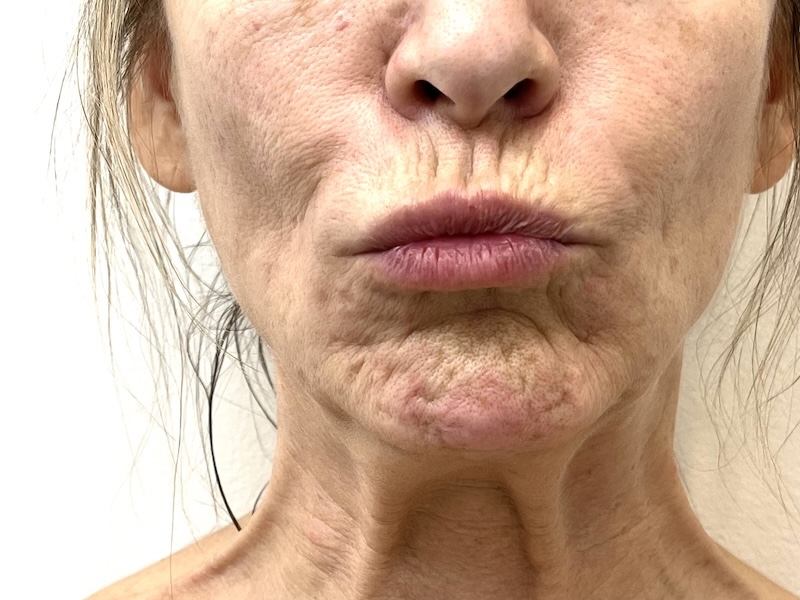 Chin Botox for Menopausal chin dimples and wrinkles Mature client with chin dimples- consultation for chin Botox