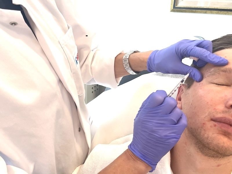Crow's Feet Botox Injection for Men Toronto Crow’s feet Botox treatment in progress