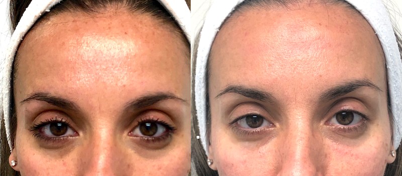 Natural Botox Results for Crow’s Feet Woman showing natural, refreshed results after Botox for crow’s feet