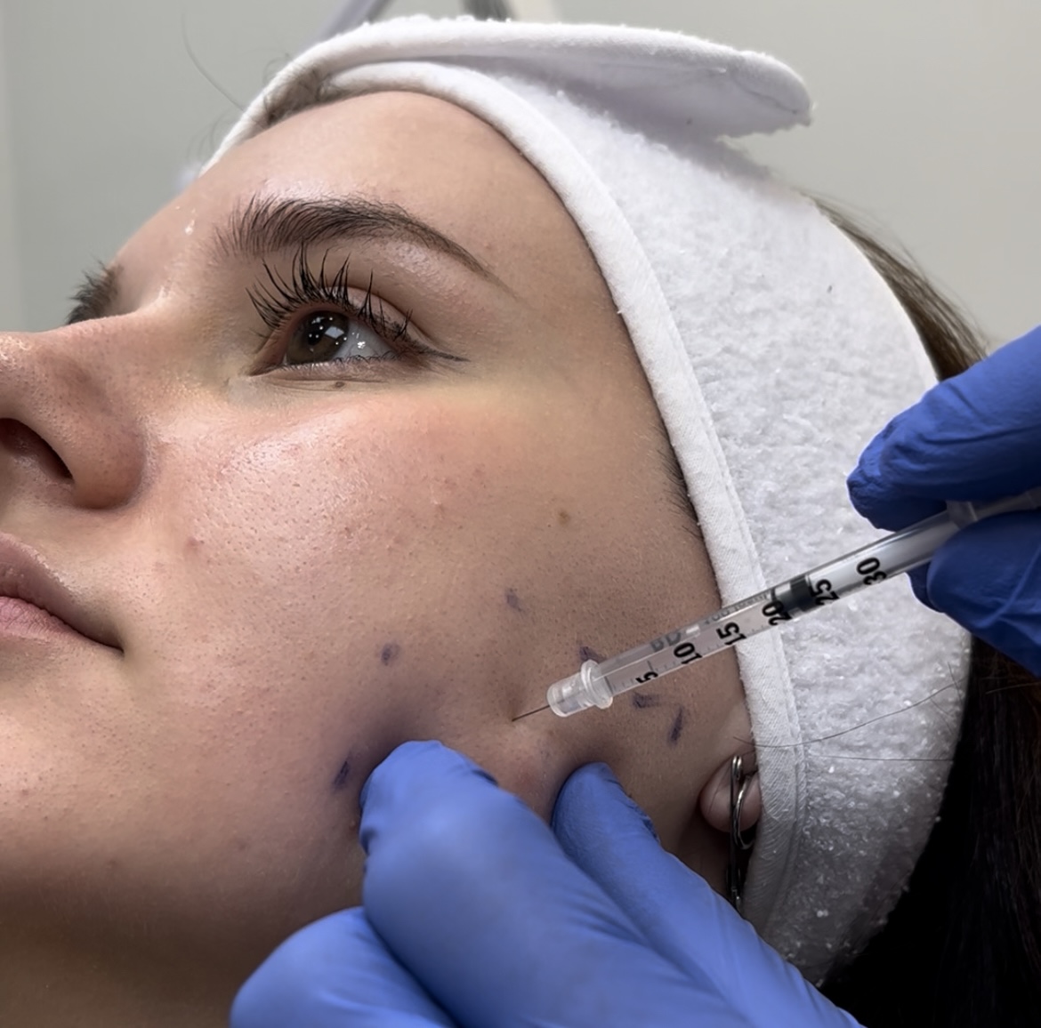 Masseter Botox Toronto jawline slimming Botox for jawline slimming and teeth grinding Toronto