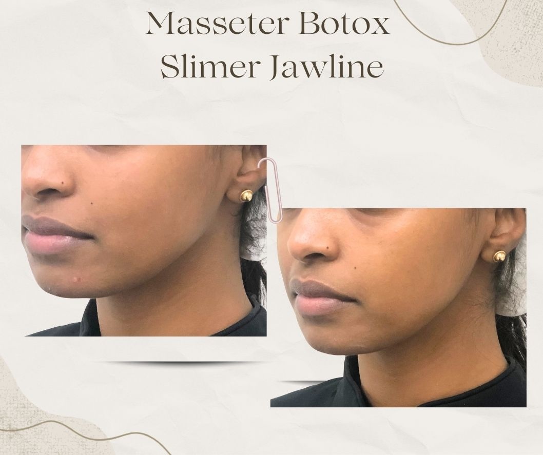 Masseter Botox result Jaw muscle relaxation result
