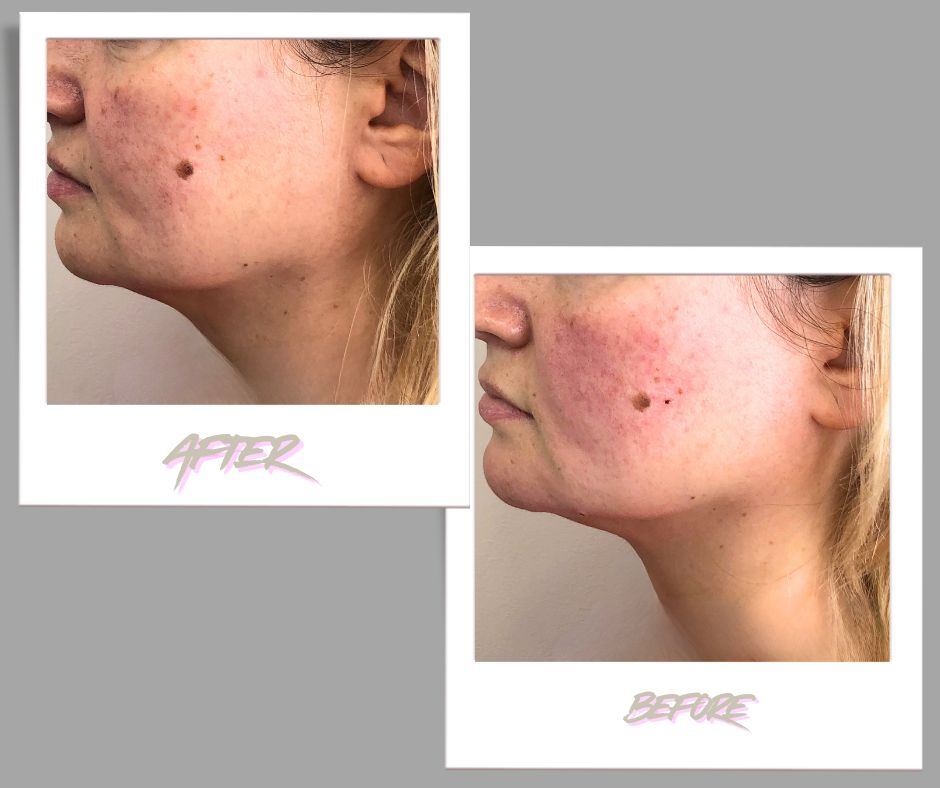 Masseter Botox Double Chin Results – MedVSPA Toronto Masseter botox double chin before after Toronto