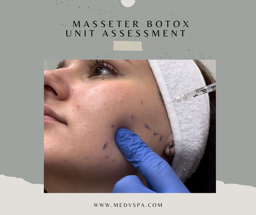 Masseter Botox Unit Assessment – MedVSPA Toronto Masseter botox unit assessment left right difference Toronto