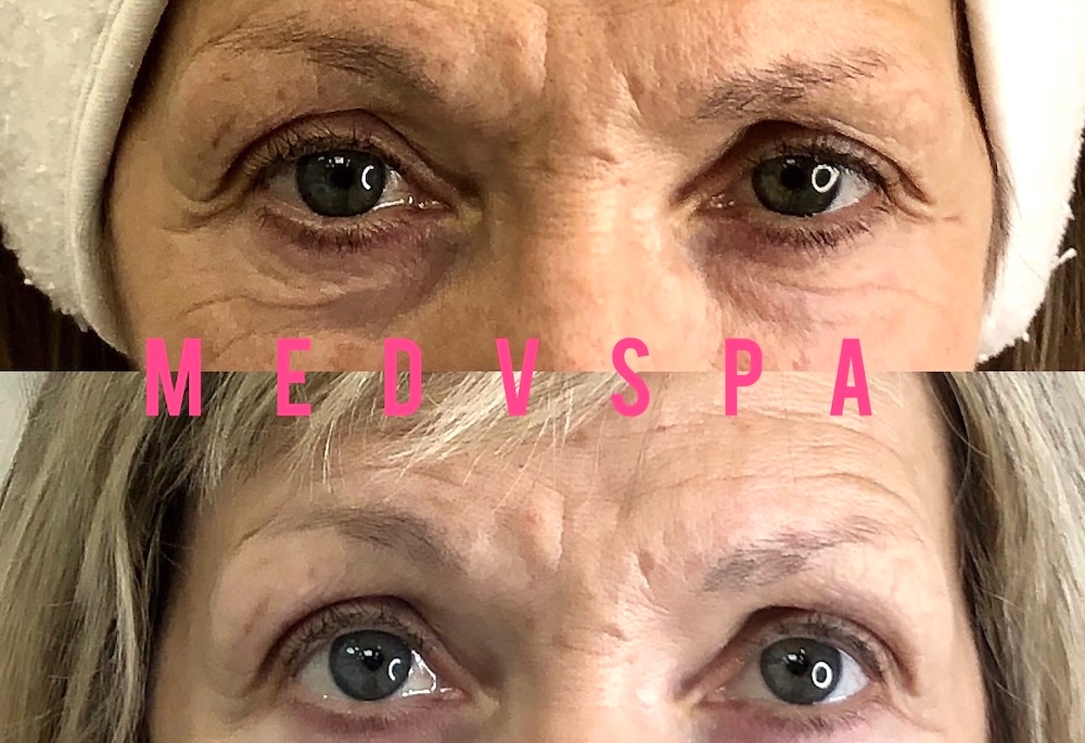 Brow Lift Botox for Menopausal Clients Botox Brow Lift treatment for peri- and menopausal women in Toronto