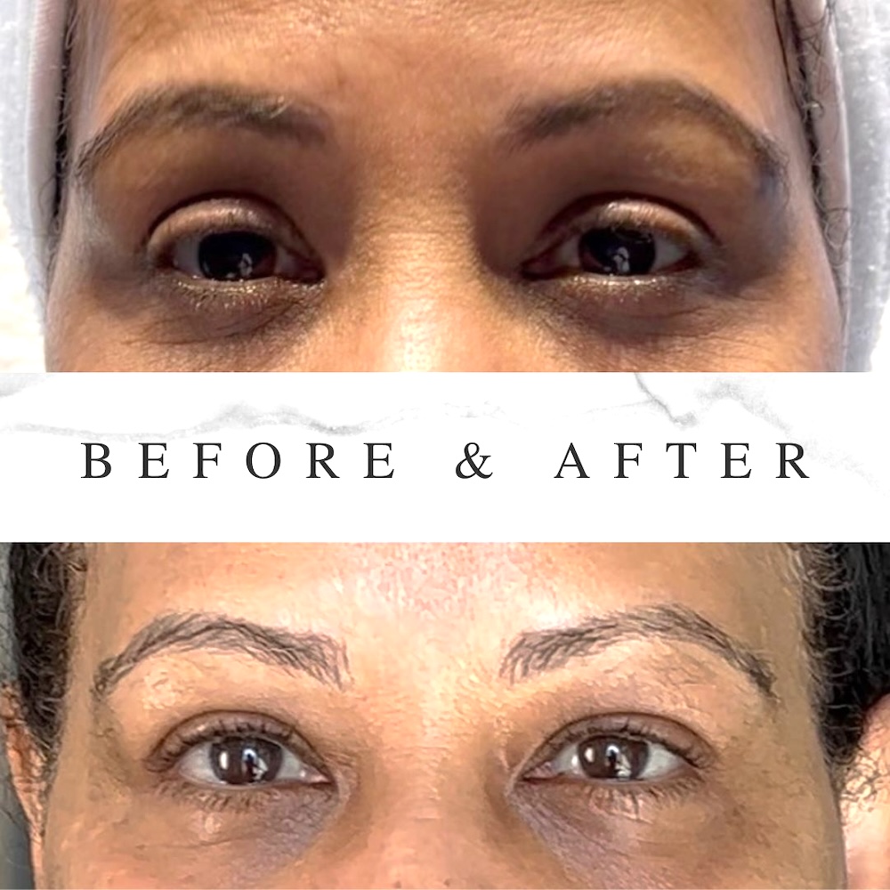 Botox Brow Lift Results Toronto Open look as Botox Brow Lift result in Toronto