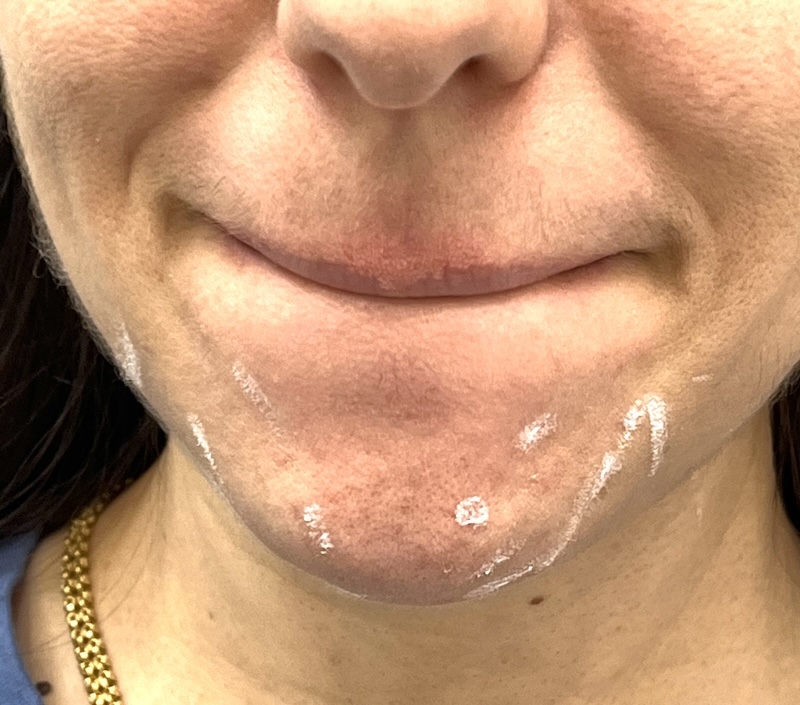 Preventive Chin Botox – Early Smoothing Young client with chin marks for preventive Botox