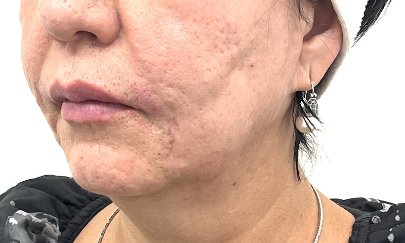 Chin filler recovery timeline Photo showing how the area looks after chin filler for aftercare steps in Toronto