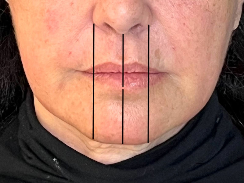 Before and after chin filler for chin width correction Before and after chin filler in Toronto showing restored chin width and symmetry