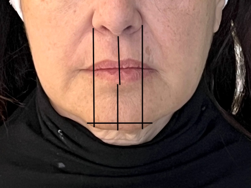 Facial ratios for chin filler assessment Diagram showing balanced nose, lip, and chin proportions for chin filler evaluation in Toronto