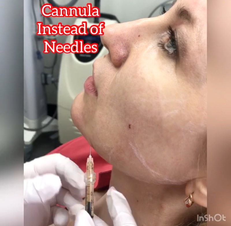 MedVSPA Yorkville chin filler experts Experienced MedVSPA team in Toronto specializing in chin fillers