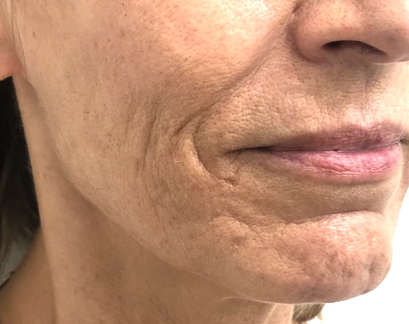 How menopause affects chin structure Photo showing how menopause affects the bone and muscle around the chin