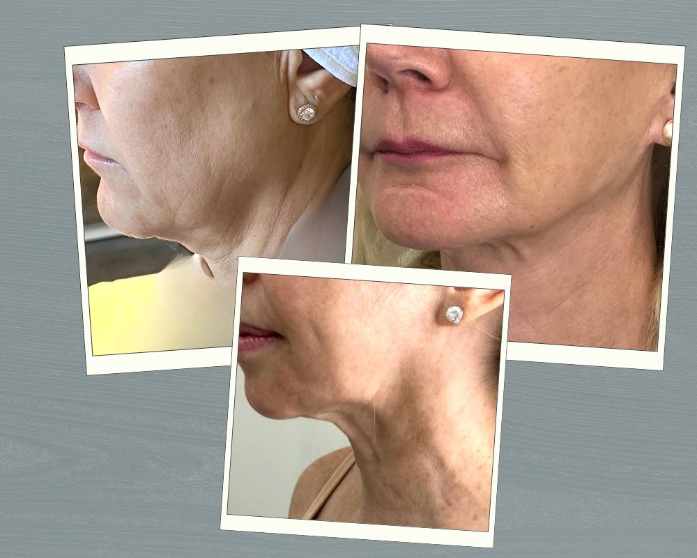 Jawline changes with age Jawline aging diagram showing differnt bone loss and tissue descent