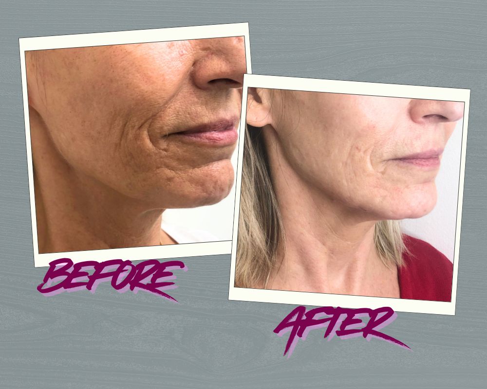 Jawline filler before and after Toronto Subtle yet visible lift — see real jawline filler before and after results.