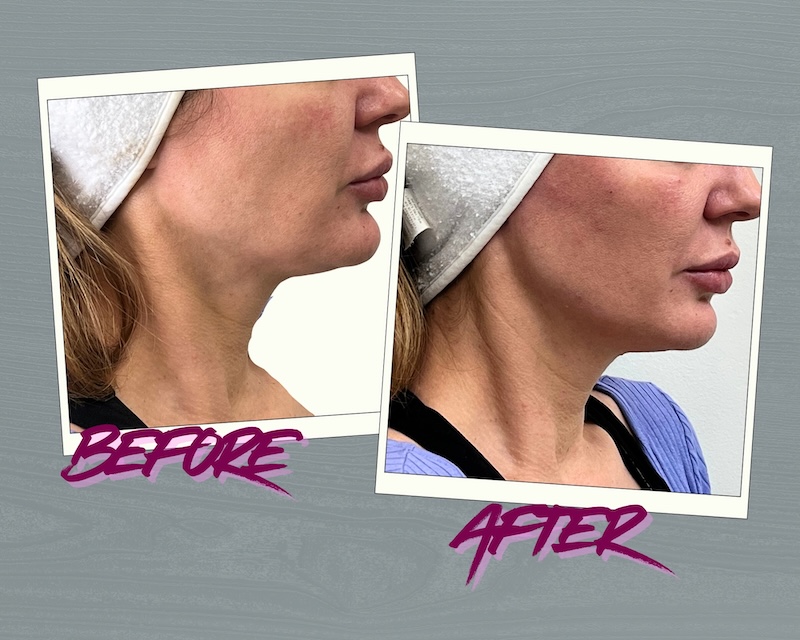 Age-specific jawline contouring Toronto jawline contouring results with filler, RF microneedling, and Botox Toronto
