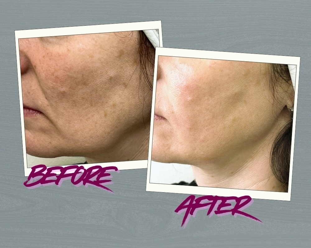 Natural jawline contouring Juvederm Voluma results Toronto Natural jawline filler Juvederm Voluma contouring results Toronto