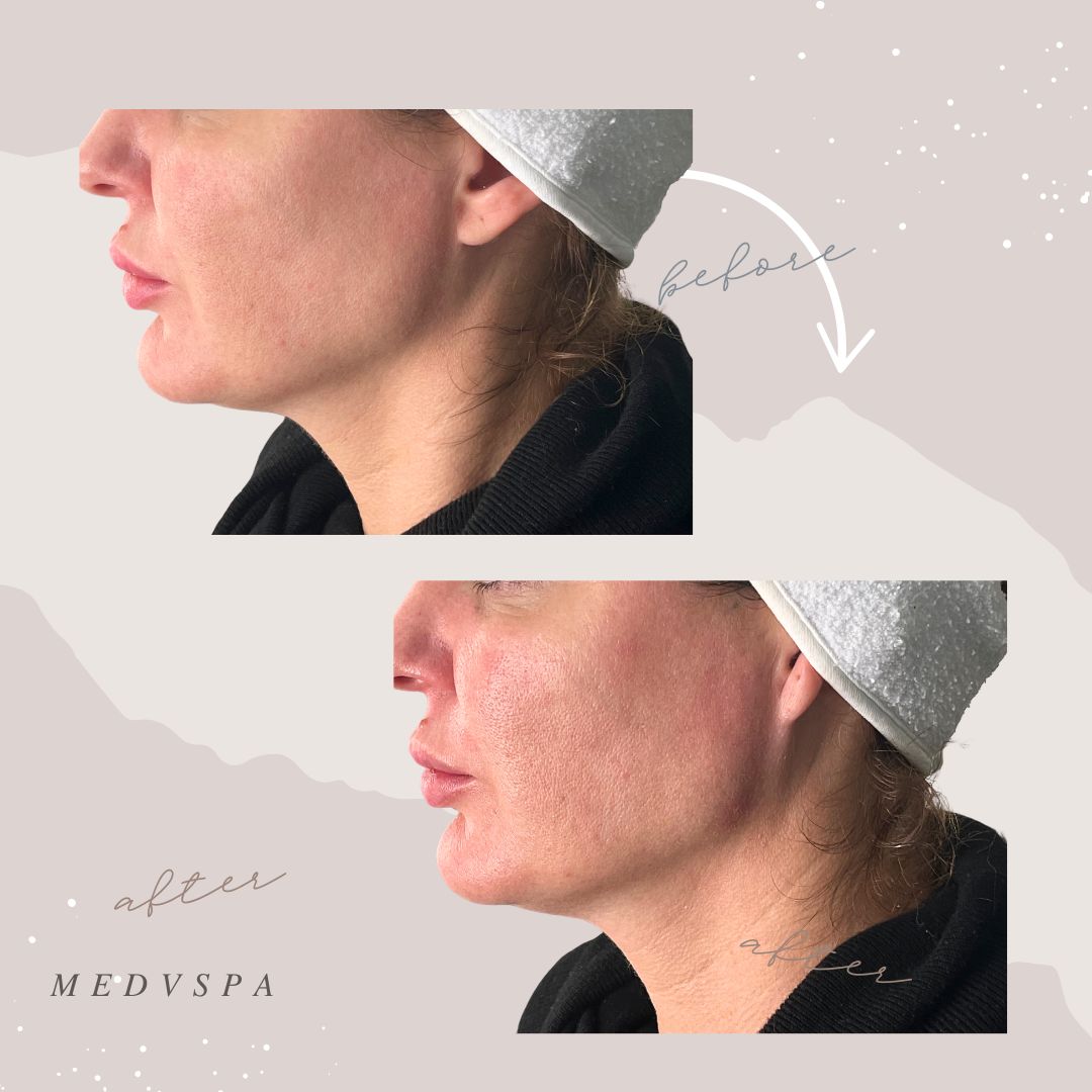 Natural resullts of jawline filler injections in Toronto Natural result after Volux, Voluma jawline filler injections.