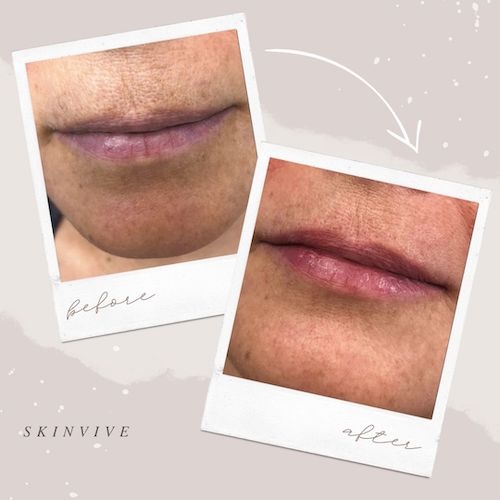 SkinVive lip enchancement result Toronto Lip enchancement result after skinvive injections