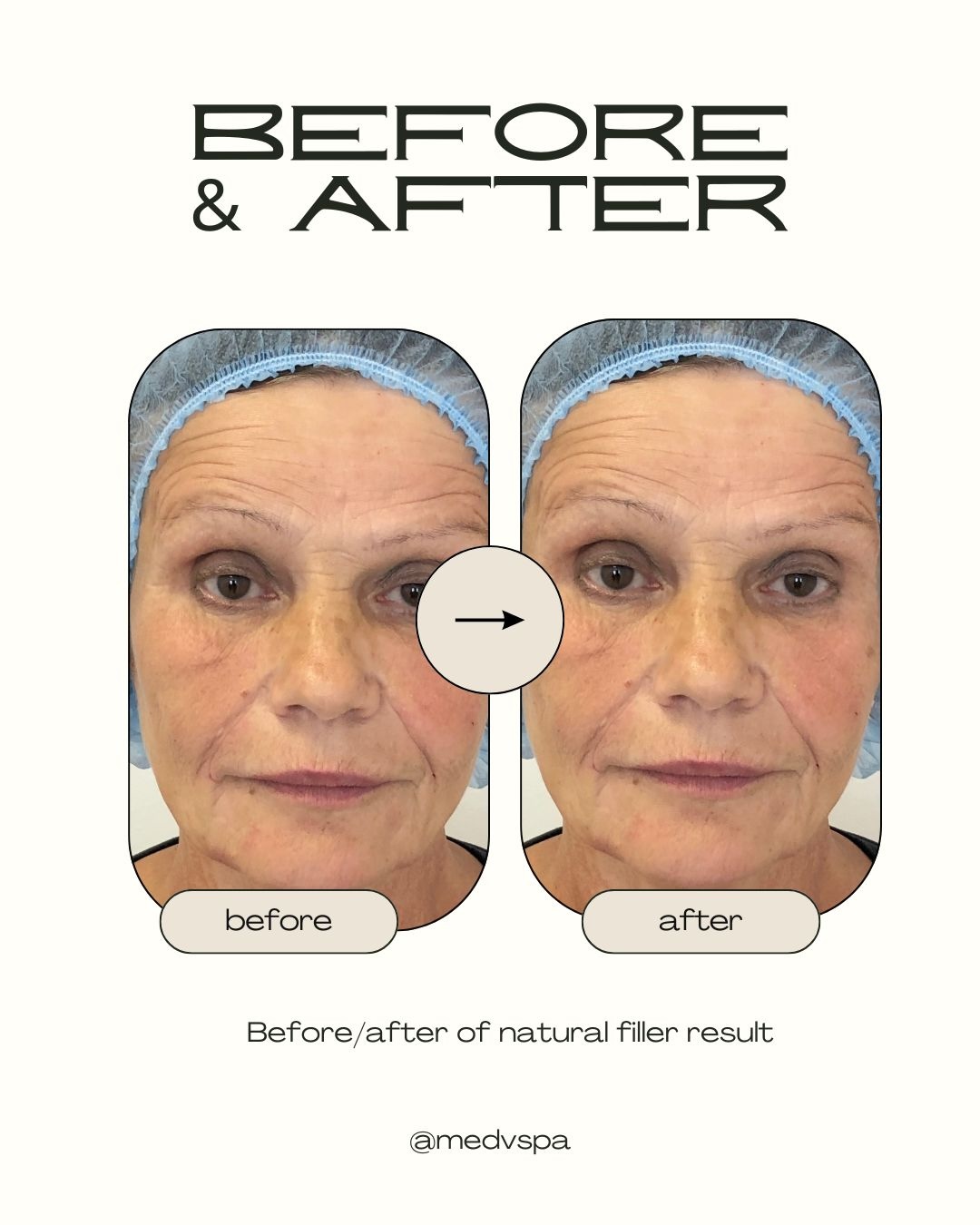 Clinical results showing SkinVive improvements in skin condition, redness and hydration Diagram showing SkinVive reducing redness and increasing hydration in mature skin client