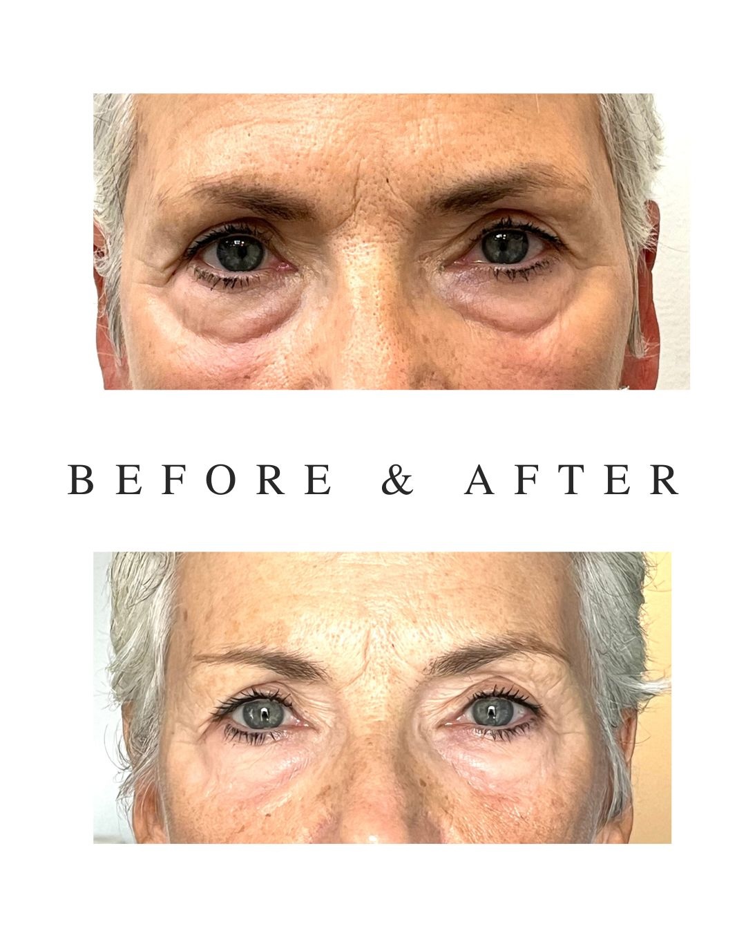Best Tear Trough Filler Toronto – Natural Results for Mature Clients Before and after tear trough filler in mature client showing natural rejuvenation in Toronto