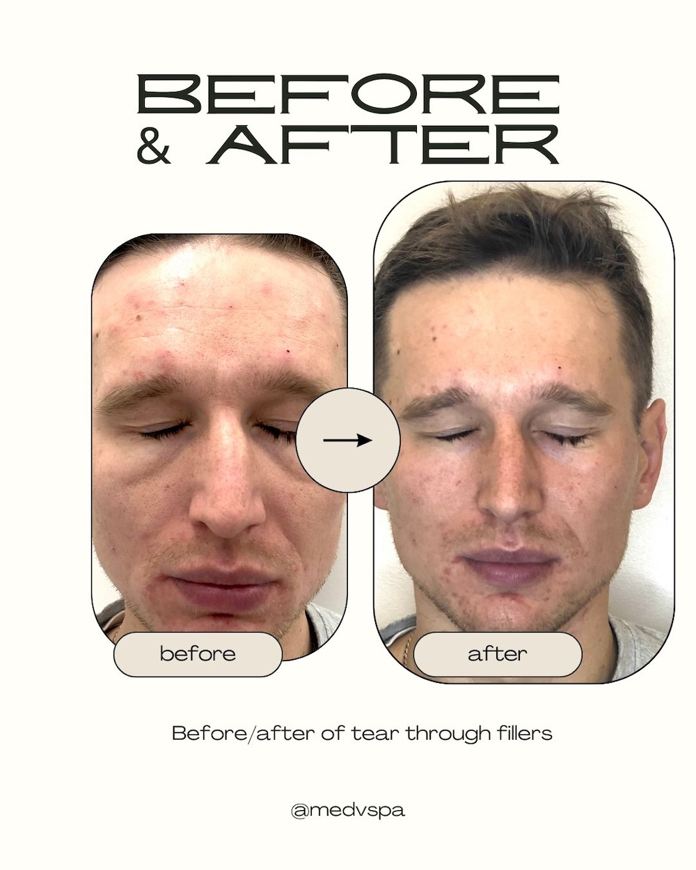 Tear Trough Filler Before and After Toronto – Natural Results Before and after under-eye filler in Toronto showing reduced hollows and dark circles