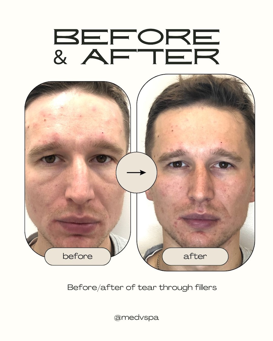 Tear Trough Filler Toronto – MedVSPA Yorkville Tear trough filler before and after in Toronto showing under-eye rejuvenation results