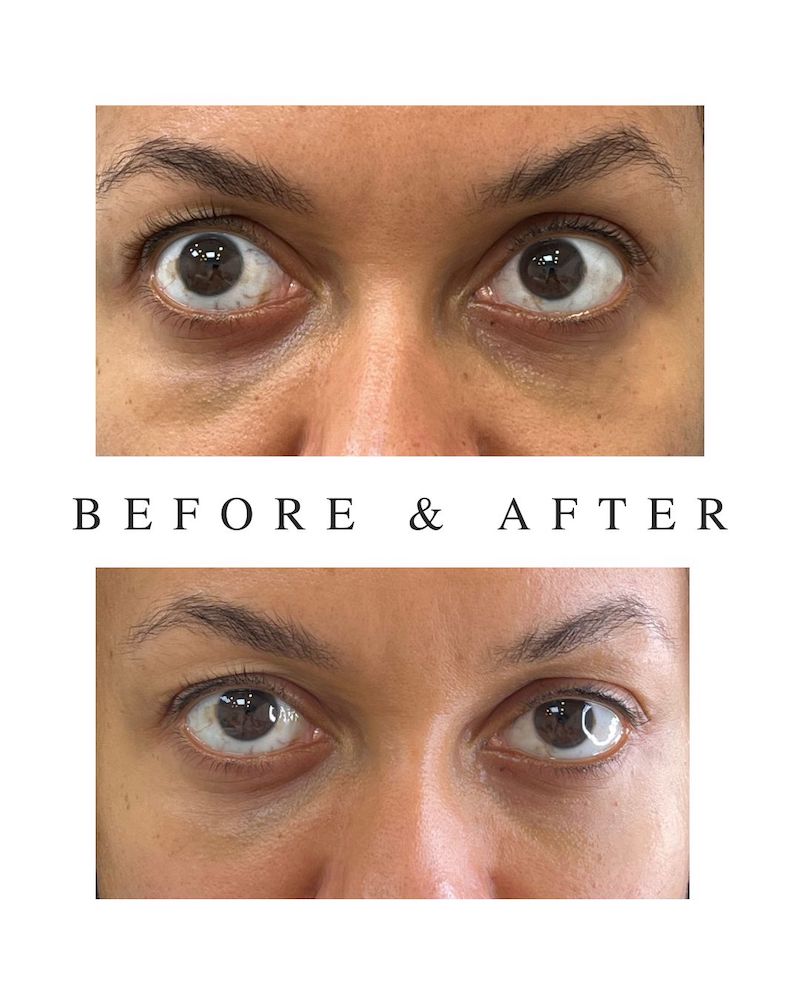 Under Eye Filler Toronto – Non-Surgical Eye Treatment before and after tear trough hyaluronic acid filler Toronto