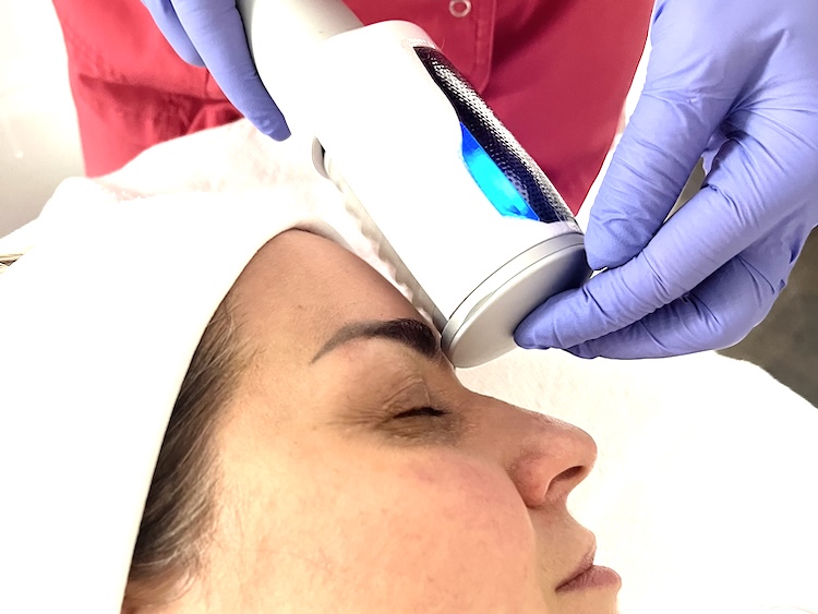 Endosphères Facial for Hooded Eyes in Toronto Client receiving Endosphères facial for hooded eyelids