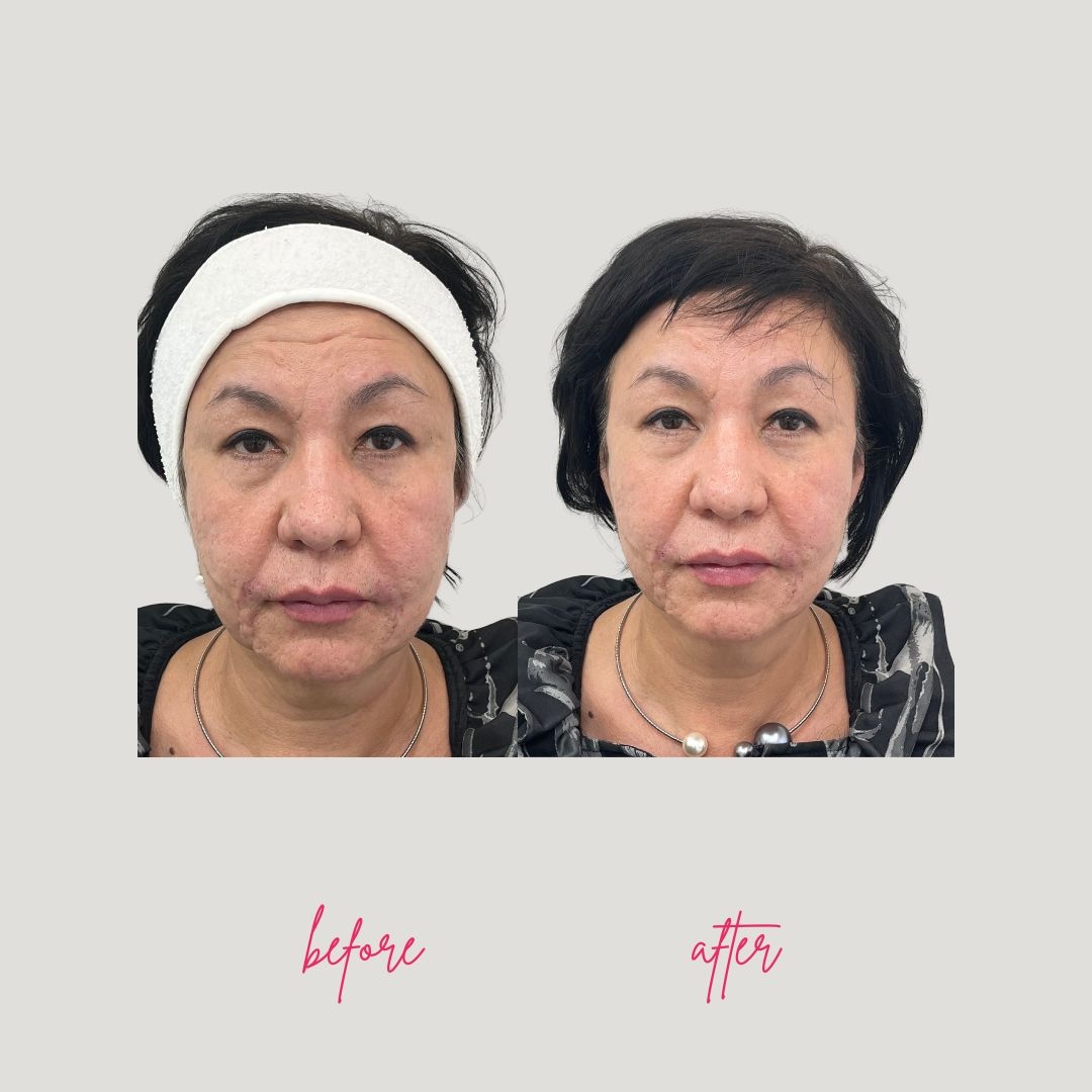 Before and After Endosphères Facial Results Facial lift and contour improvement before and after endospheres treatment