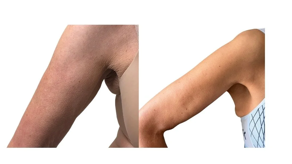 Endospheress results for arms skin tightening and contouring