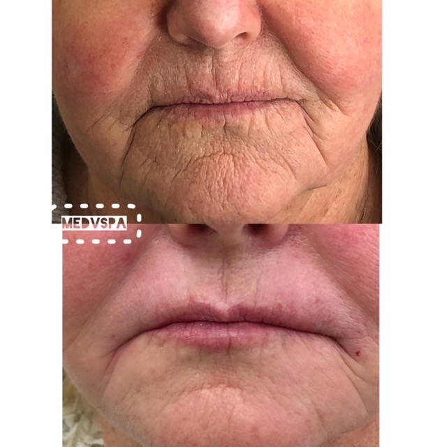 Chin Botox Before and After
