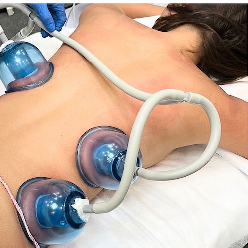 Cellulite treatment session at MedVSPA Therapist using Starvac machine on client’s back in Toronto clinic