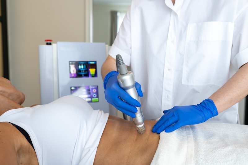 Sylfirm X for RF microneedling body treatment RF microneedling body Toronto